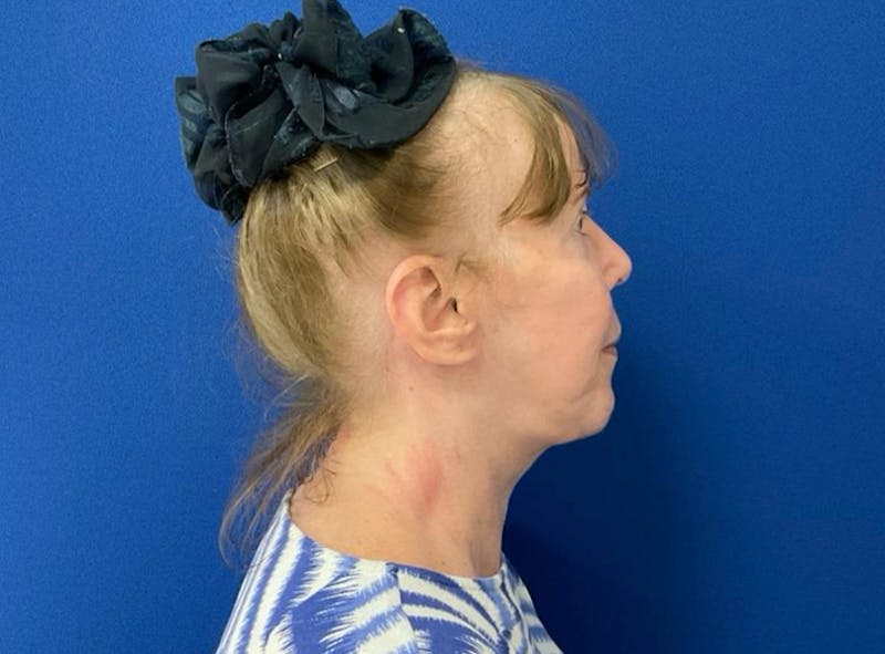 Neck Lift Before & After Gallery - Patient 238882 - Image 6