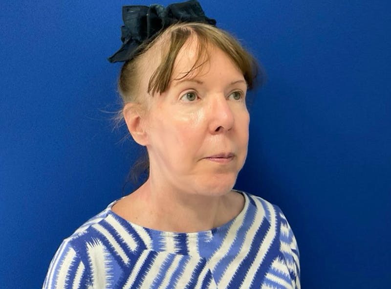Neck Lift Before & After Gallery - Patient 238882 - Image 10