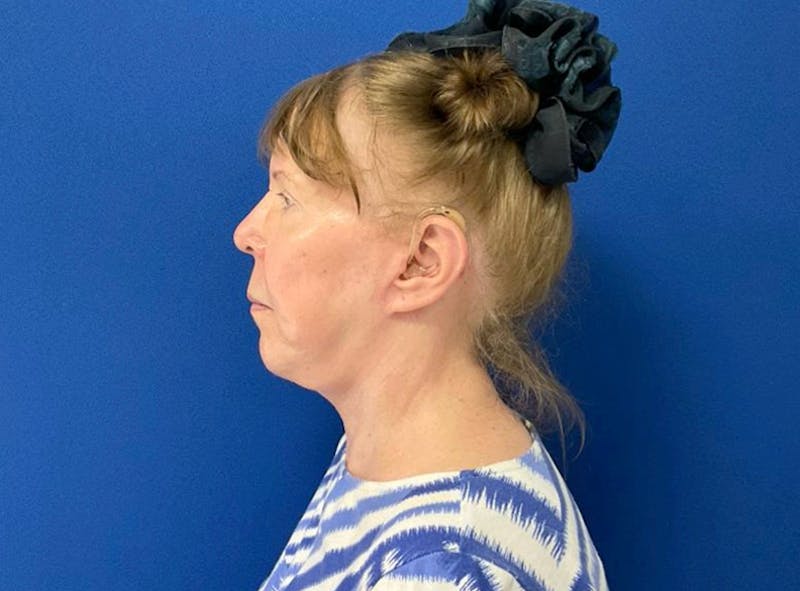Neck Lift Before & After Gallery - Patient 238882 - Image 8