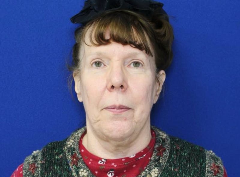 Neck Lift Before & After Gallery - Patient 238882 - Image 3