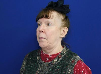Facelift Before & After Gallery - Patient 175900 - Image 1