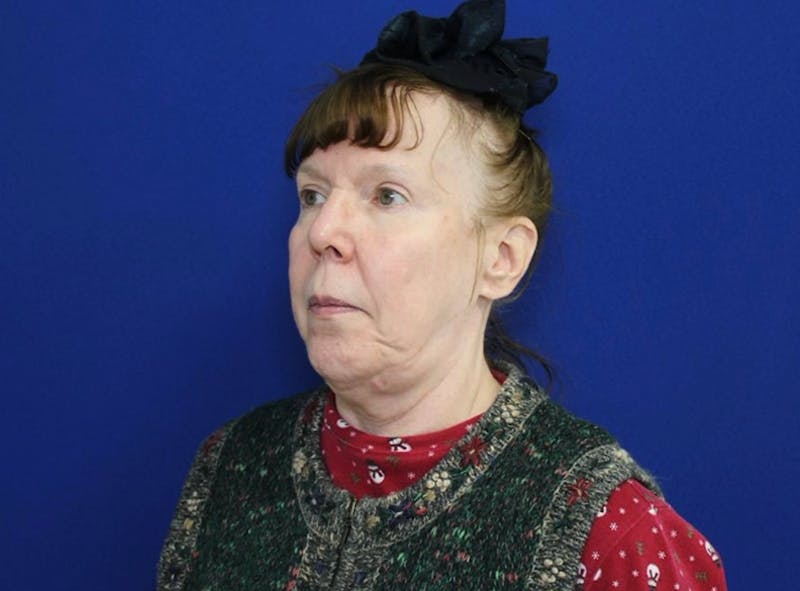 Neck Lift Before & After Gallery - Patient 238882 - Image 1