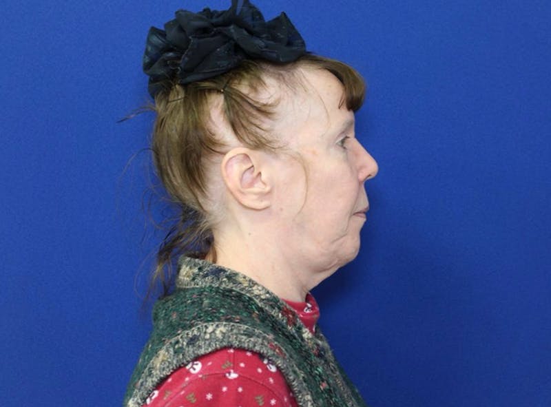 Neck Lift Before & After Gallery - Patient 238882 - Image 5