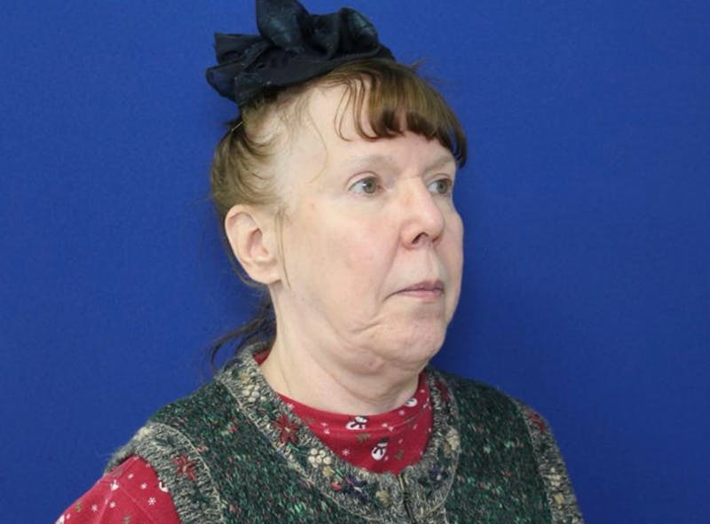 Neck Lift Before & After Gallery - Patient 238882 - Image 9