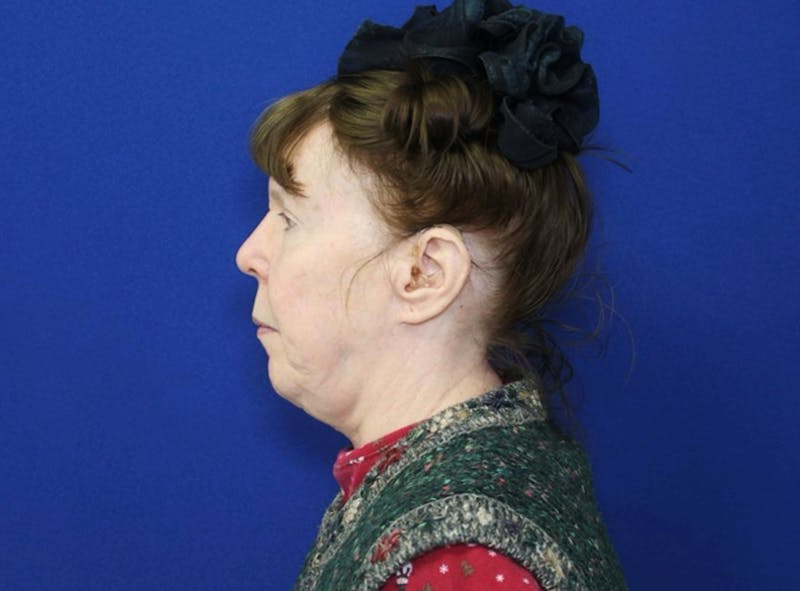 Neck Lift Before & After Gallery - Patient 238882 - Image 7