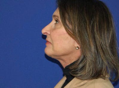 Neck Lift Before & After Gallery - Patient 353297 - Image 2