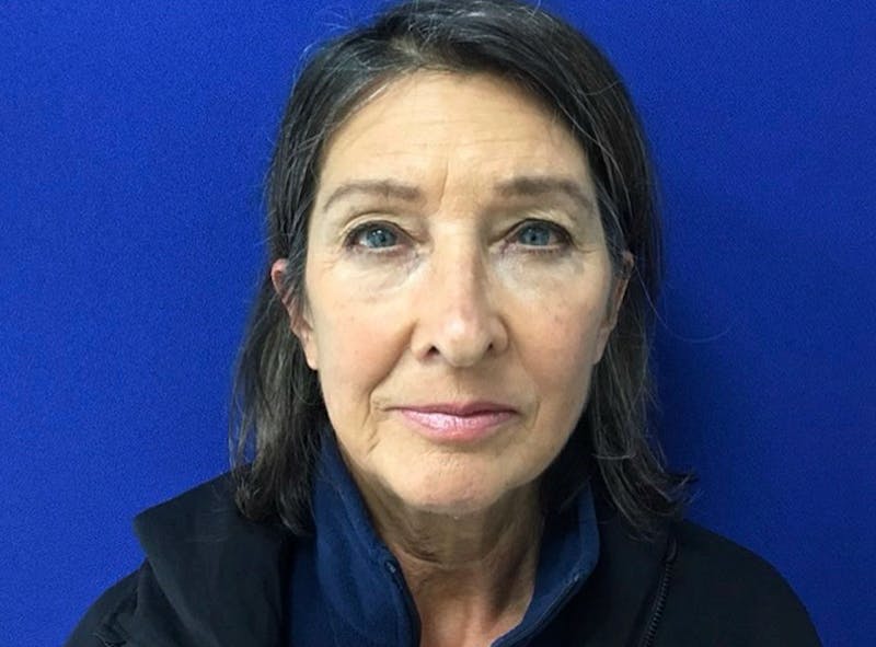 Facelift Before & After Gallery - Patient 176093 - Image 3