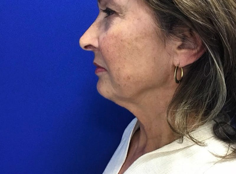 Facelift Before & After Gallery - Patient 176093 - Image 1