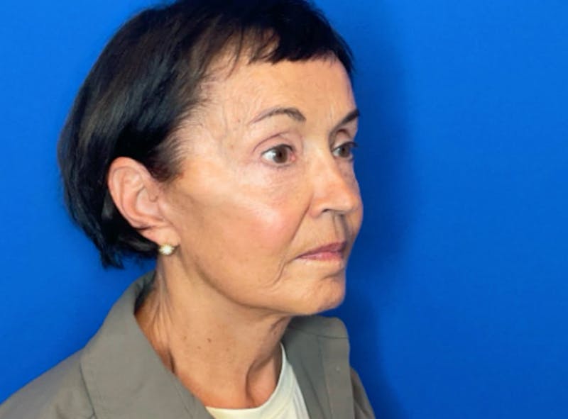 Facelift Before & After Gallery - Patient 230499 - Image 6
