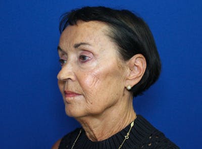Facelift Before & After Gallery - Patient 230499 - Image 1