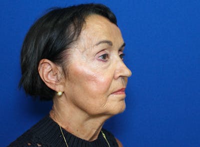 Lower Eyelid Surgery Before & After Gallery - Patient 295248 - Image 1