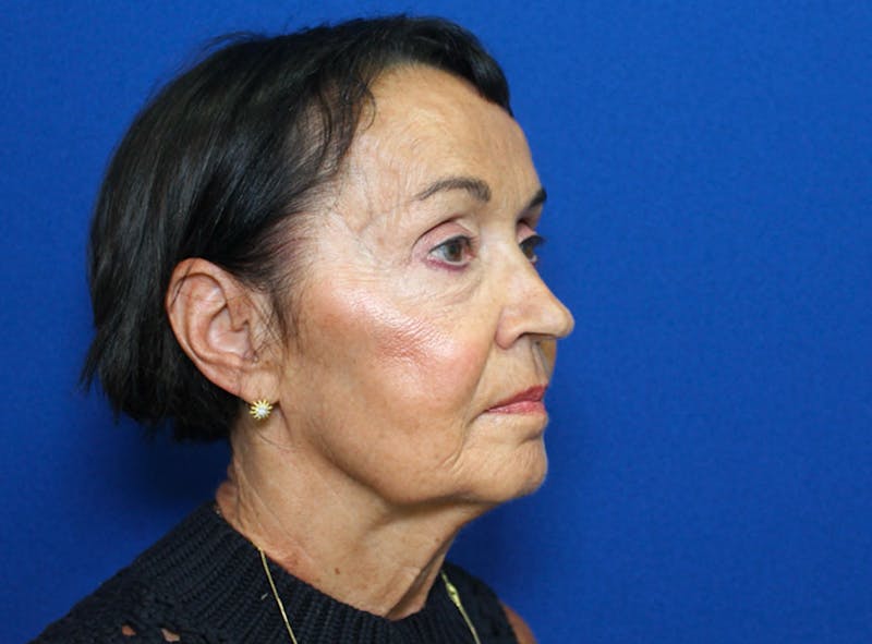 Facelift Before & After Gallery - Patient 230499 - Image 5