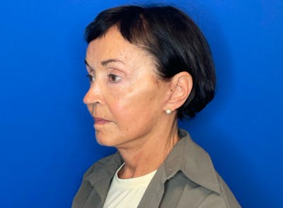 Neck Lift Before & After Gallery - Patient 403322 - Image 2