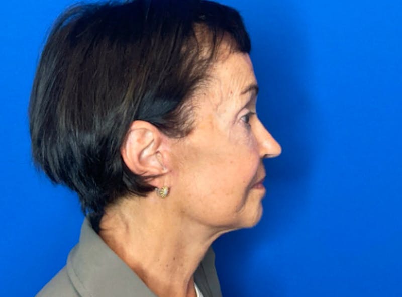 Facelift Before & After Gallery - Patient 230499 - Image 4