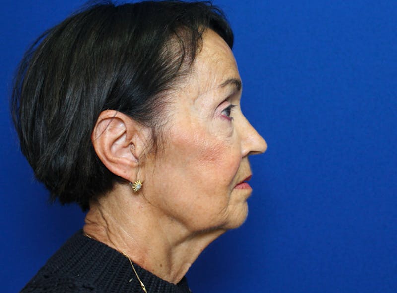 Facelift Before & After Gallery - Patient 230499 - Image 3