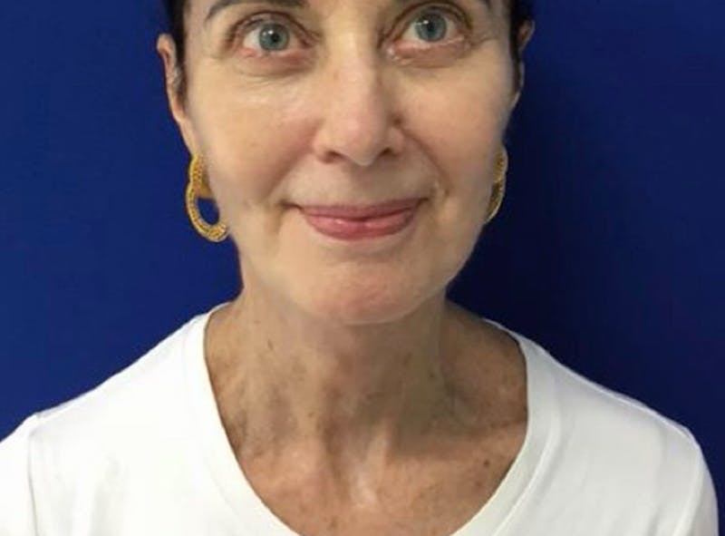 Facelift Before & After Gallery - Patient 248497 - Image 4