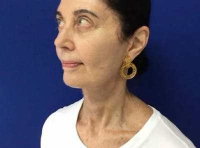 Neck Lift Before & After Gallery - Patient 231843 - Image 2