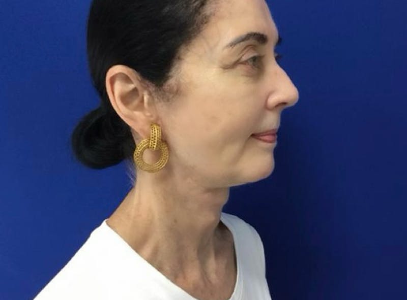 Facelift Before & After Gallery - Patient 248497 - Image 6