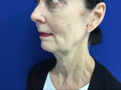 Facelift Before & After Gallery - Patient 248497 - Image 1