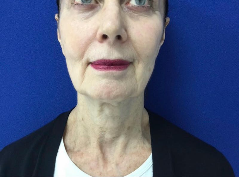 Facelift Before & After Gallery - Patient 248497 - Image 3