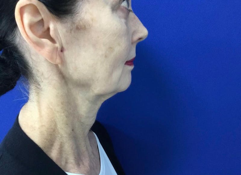 Facelift Before & After Gallery - Patient 248497 - Image 5