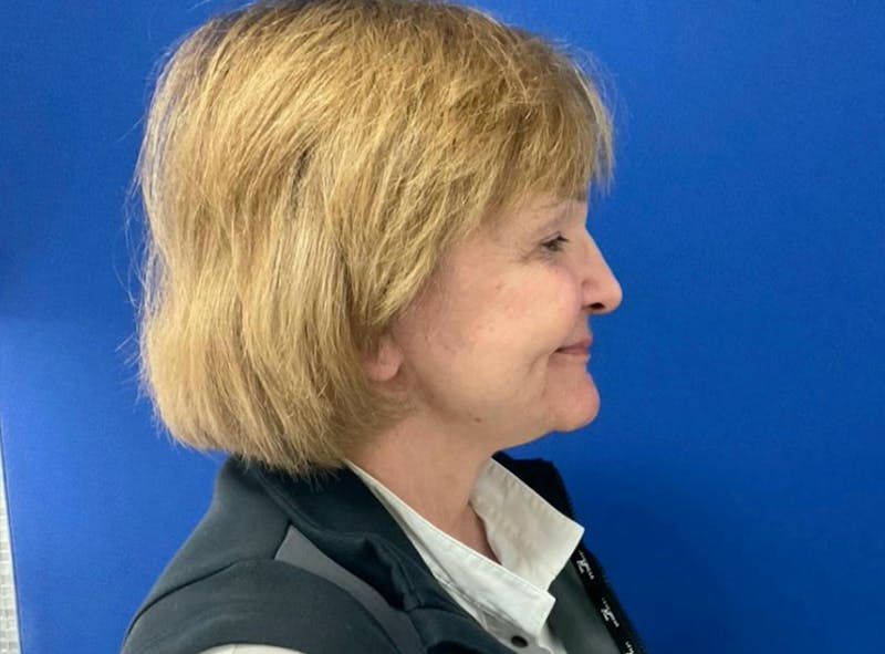 Facelift Before & After Gallery - Patient 363943 - Image 4
