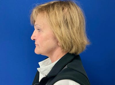 Facelift Before & After Gallery - Patient 363943 - Image 2