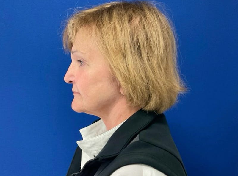 Facelift Before & After Gallery - Patient 363943 - Image 2