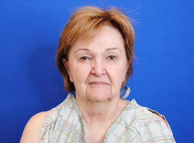 Upper Eyelid Surgery Before & After Gallery - Patient 362082 - Image 1