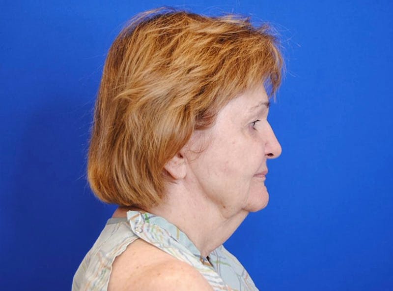 Facelift Before & After Gallery - Patient 363943 - Image 3