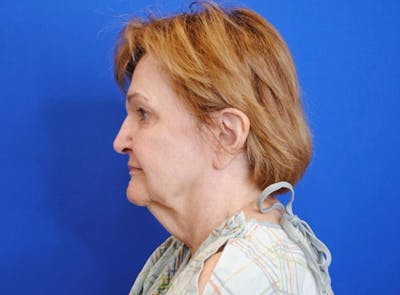 Facelift Before & After Gallery - Patient 363943 - Image 1