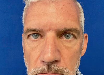Lower Eyelid Surgery Before & After Gallery - Patient 549641 - Image 2