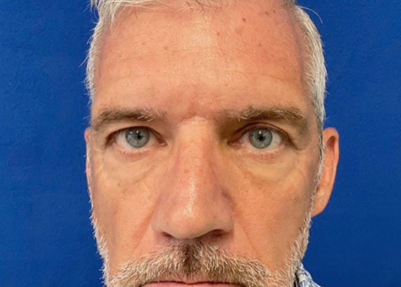 Lower Eyelid Surgery Before & After Gallery - Patient 549641 - Image 2