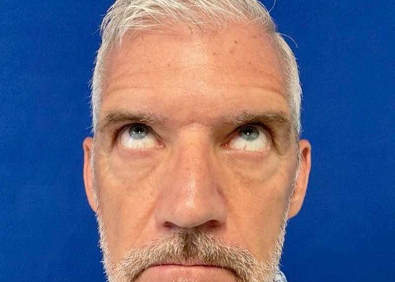 Lower Eyelid Surgery Before & After Gallery - Patient 549641 - Image 4