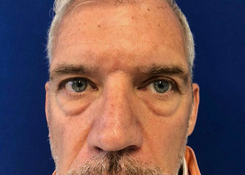 Lower Eyelid Surgery Before & After Gallery - Patient 549641 - Image 1