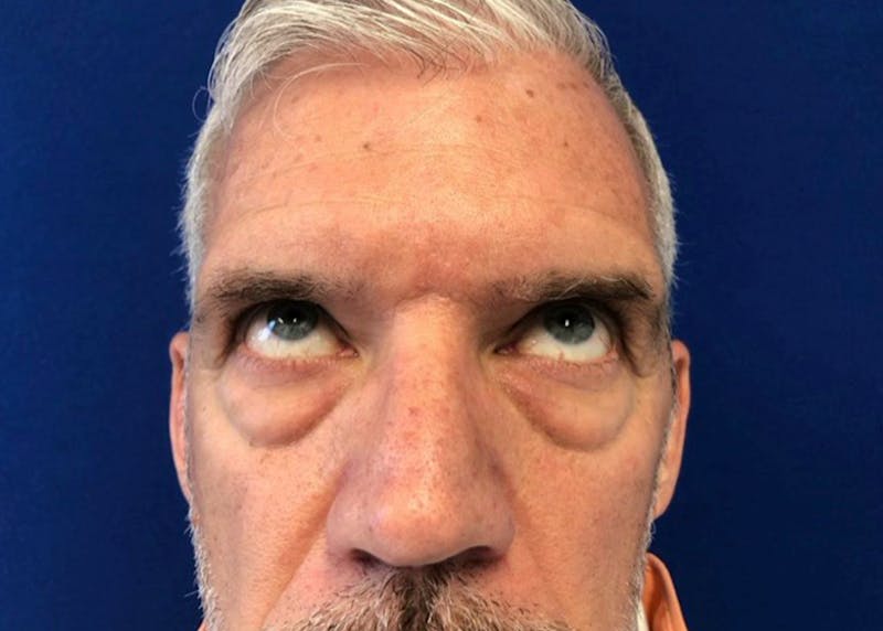 Lower Eyelid Surgery Before & After Gallery - Patient 549641 - Image 3