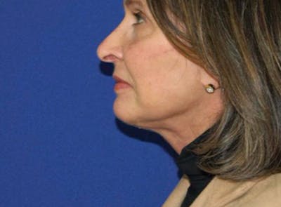 Facelift Before & After Gallery - Patient 176093 - Image 2