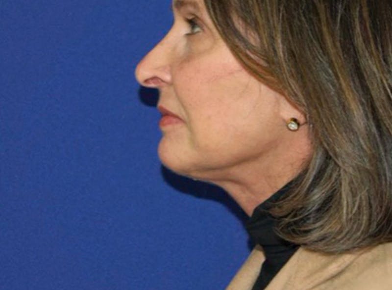 Facelift Before & After Gallery - Patient 176093 - Image 2