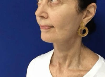 Facelift Before & After Gallery - Patient 248497 - Image 2