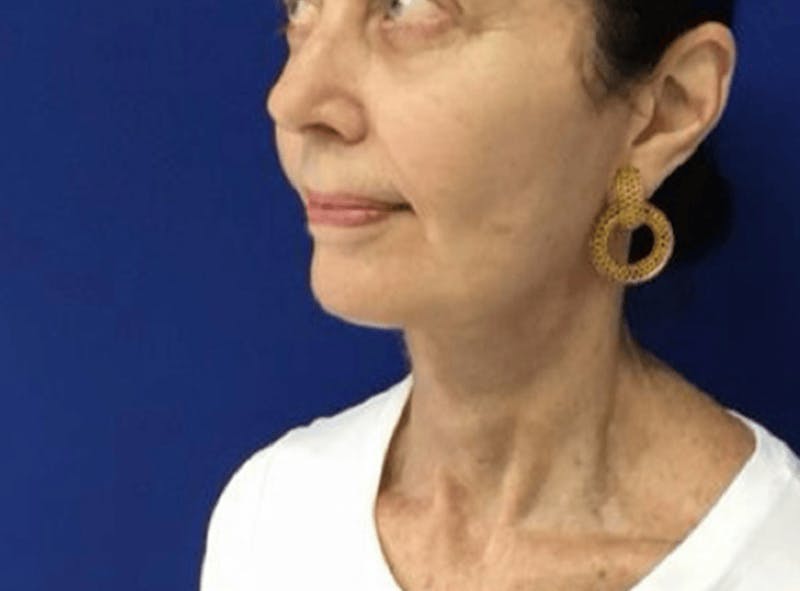 Facelift Before & After Gallery - Patient 248497 - Image 2