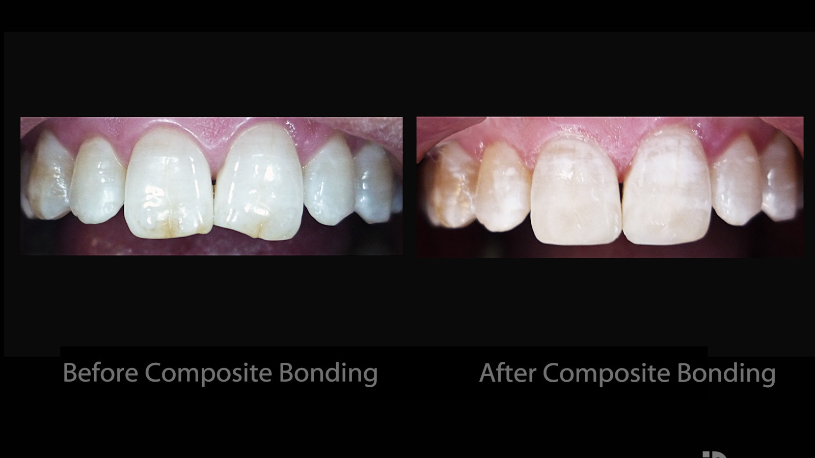 Before- After Bonding
