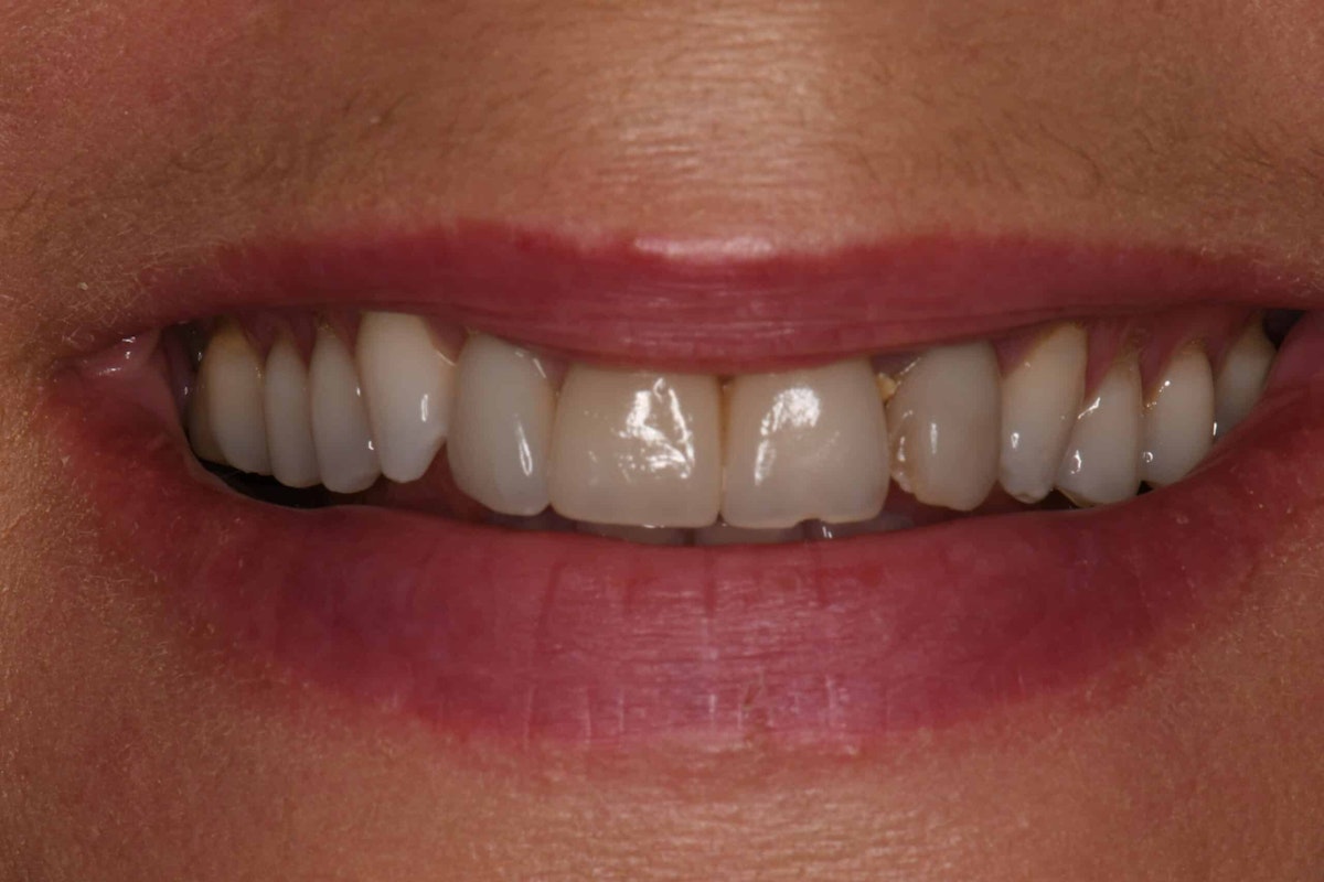Smile before porcelain veneer treatment