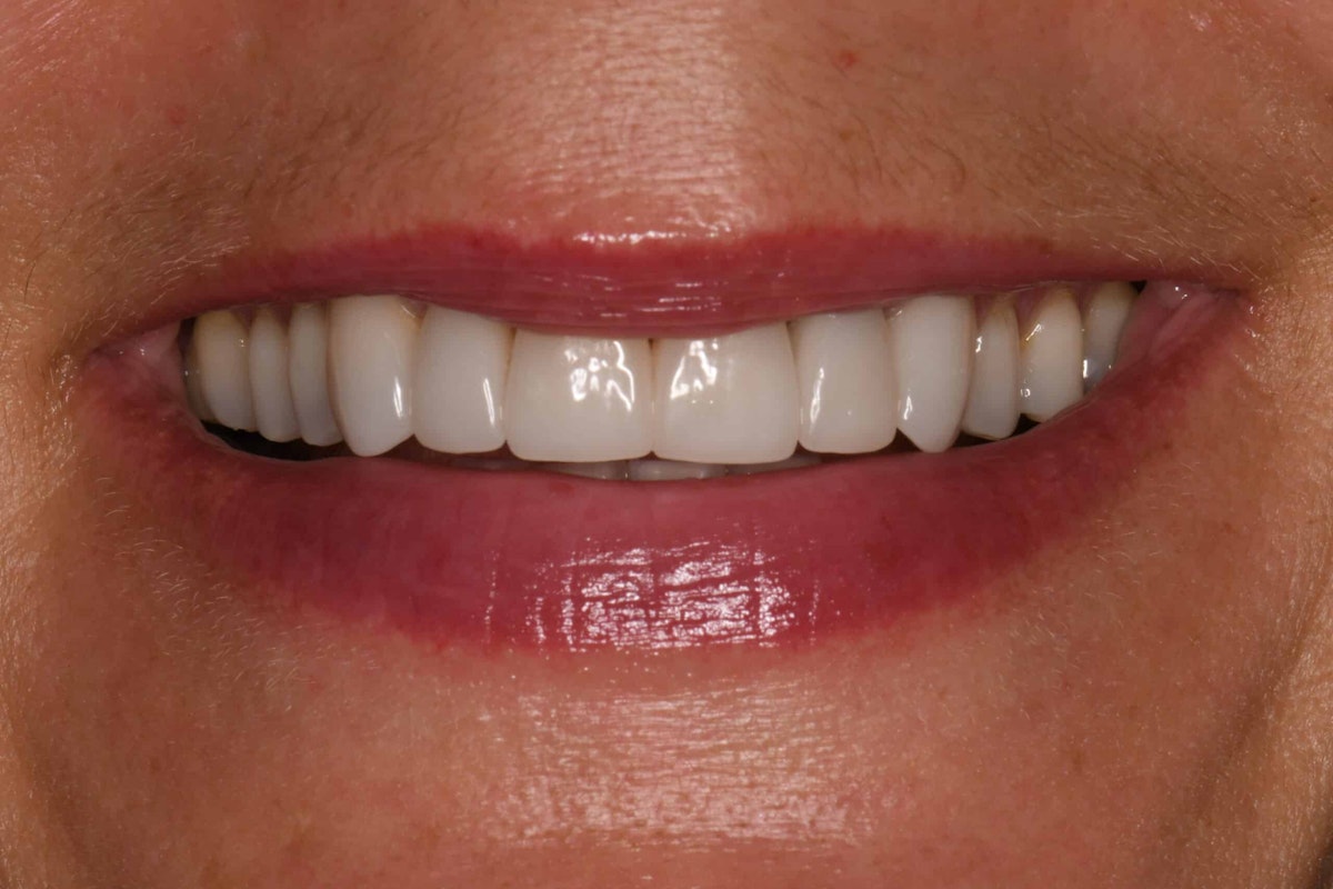 Smile after porcelain veneer treatment