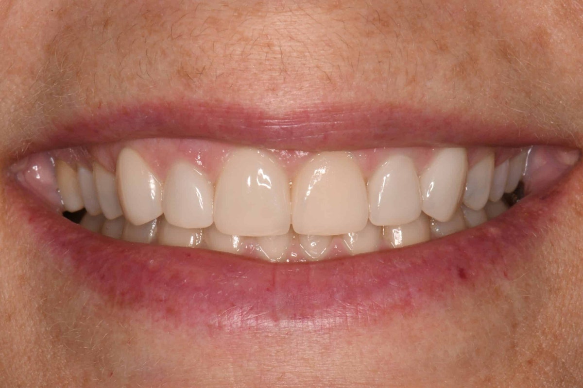 Smile after makeover