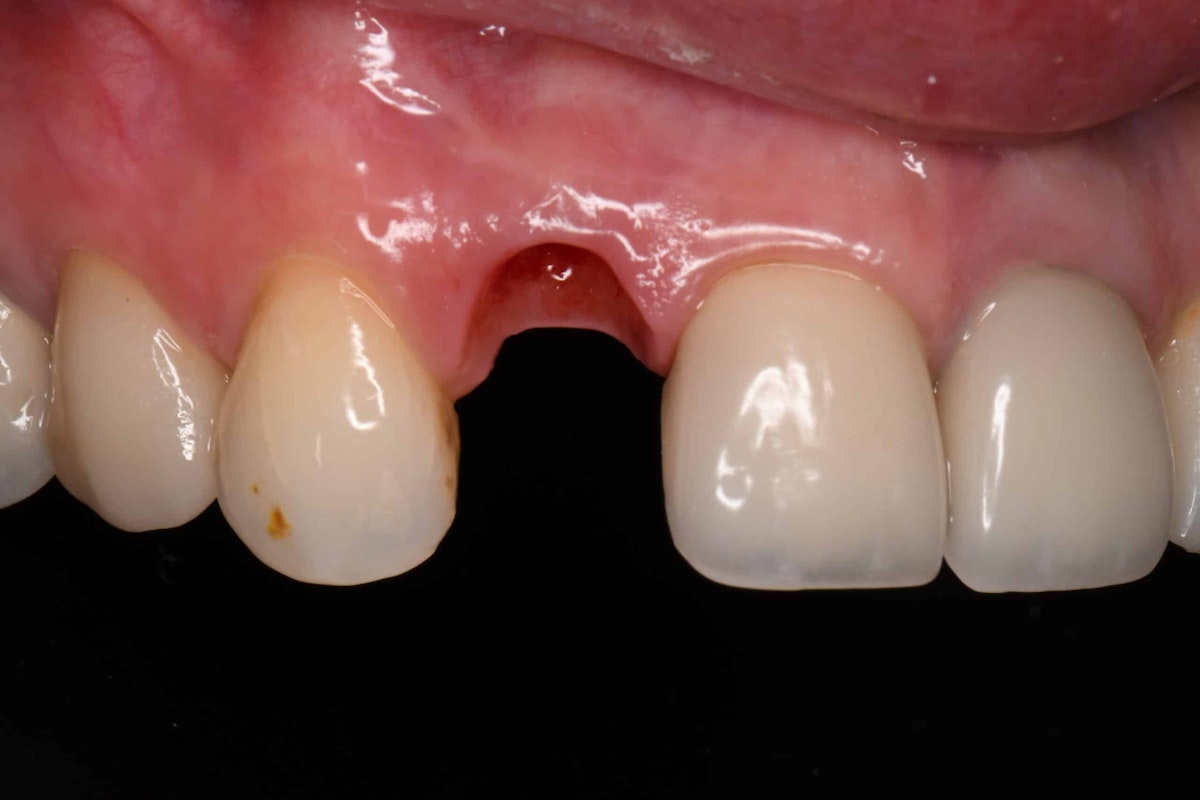 Smile before single-tooth implant