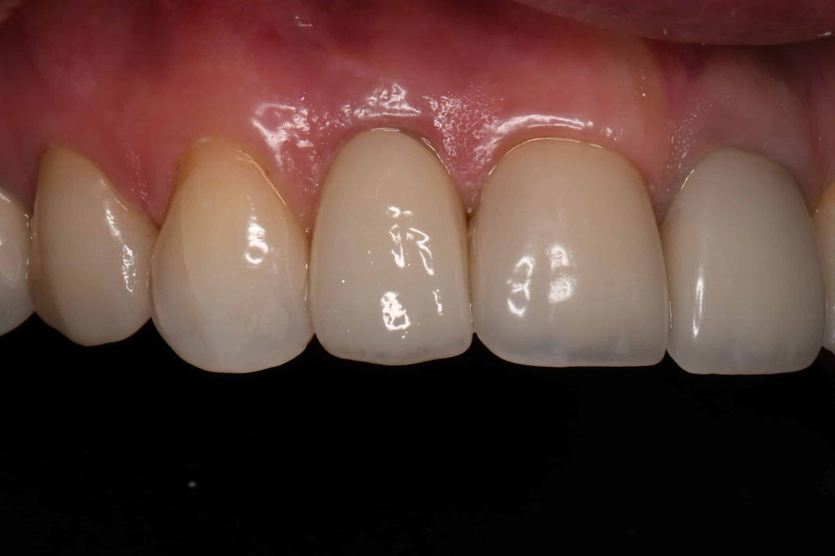 Smile after single-tooth implant