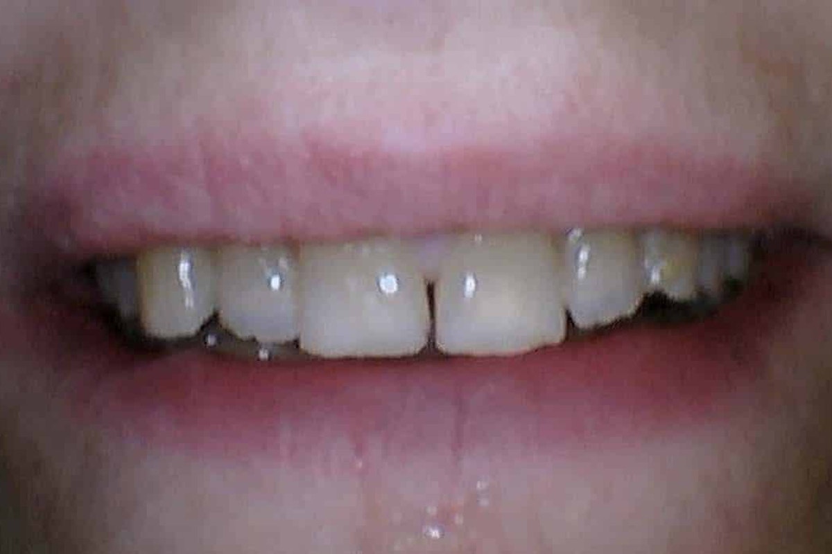 Smile before porcelain veneer treatment