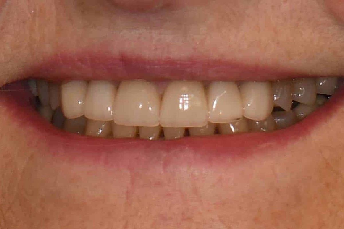 Smile after porcelain veneer treatment