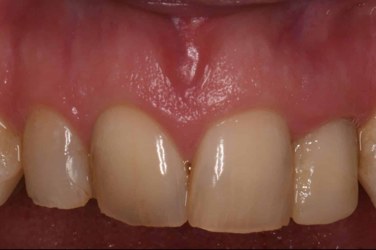 Smile before porcelain crowns