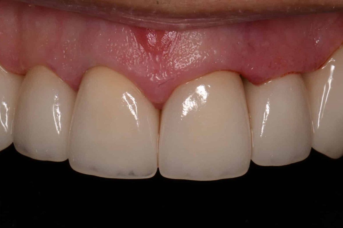 Smile after porcelain crowns